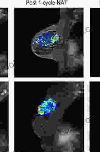 Contrast Enhanced MRI Of The Breast