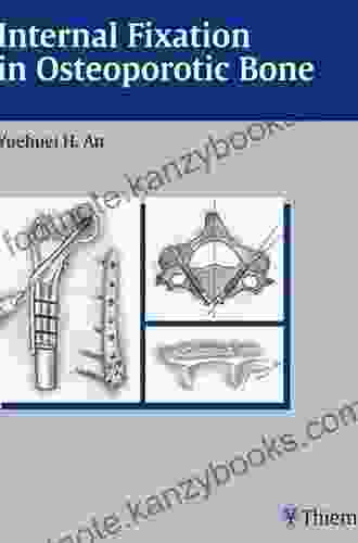 Internal Fixation in Osteoporotic Bone